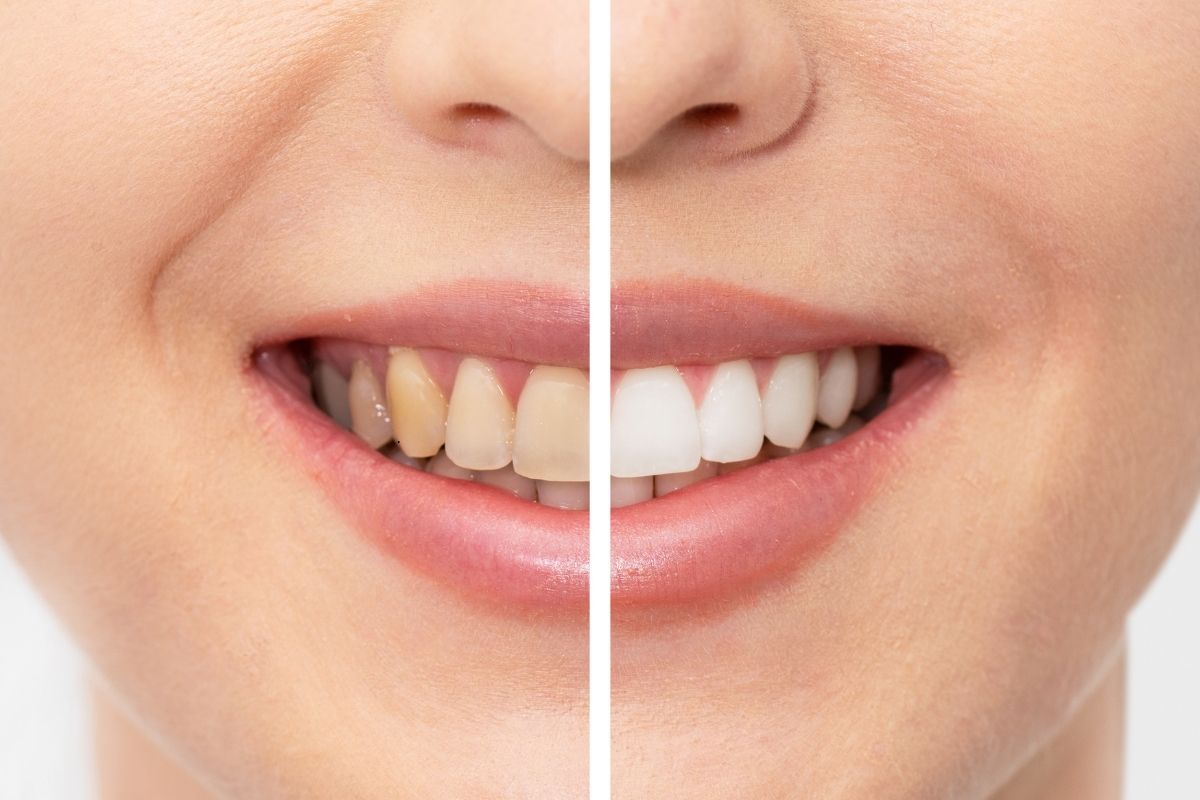 Teeth Whitening in Henderson