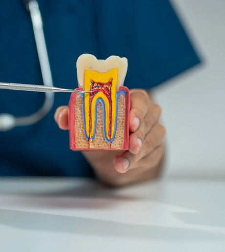 A 3D illustration of a tooth cross section showing the root canal structure used for patient education