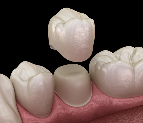 Dental Crowns