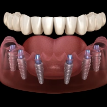 All-on-4® or All-on-6® Implants