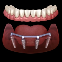 Full-Arch Implant Solutions