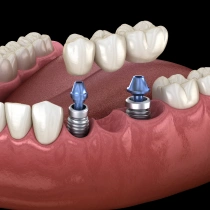 Implant-Supported Bridges