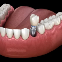 Single Tooth Implants