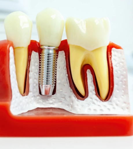 A detailed anatomical illustration of a dental implant showing the crown abutment and root structure